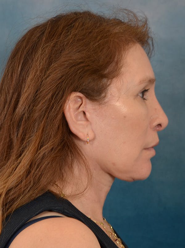 Fat Transfer Before & After Gallery - Patient 707648 - Image 10
