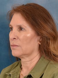 Deep Plane Facelift Before & After Gallery - Patient 148969 - Image 1