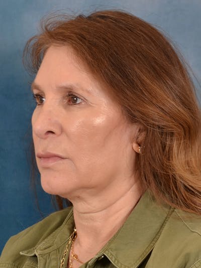 Deep Plane Facelift Before & After Gallery - Patient 286283 - Image 1