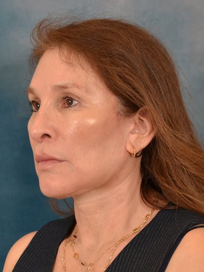 Fat Transfer Before & After Gallery - Patient 707648 - Image 4