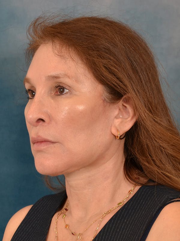 Fat Transfer Before & After Gallery - Patient 707648 - Image 4