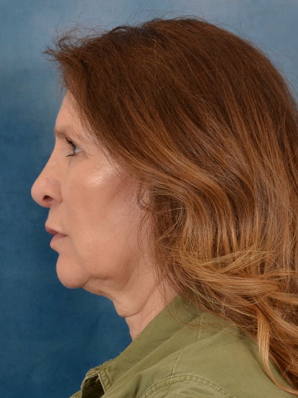 Fat Transfer Before & After Gallery - Patient 707648 - Image 5