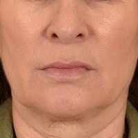 Lip Lift Before & After Gallery - Patient 171994 - Image 1