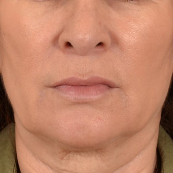 Lip Lift Before & After Gallery - Patient 171994 - Image 1