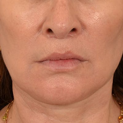 Lip Lift Before & After Gallery - Patient 171994 - Image 2