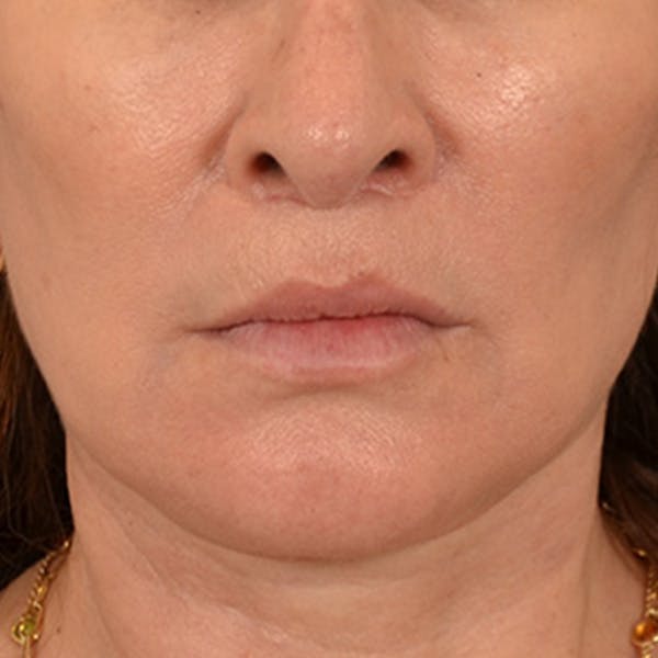 Lip Lift Before & After Gallery - Patient 171994 - Image 2