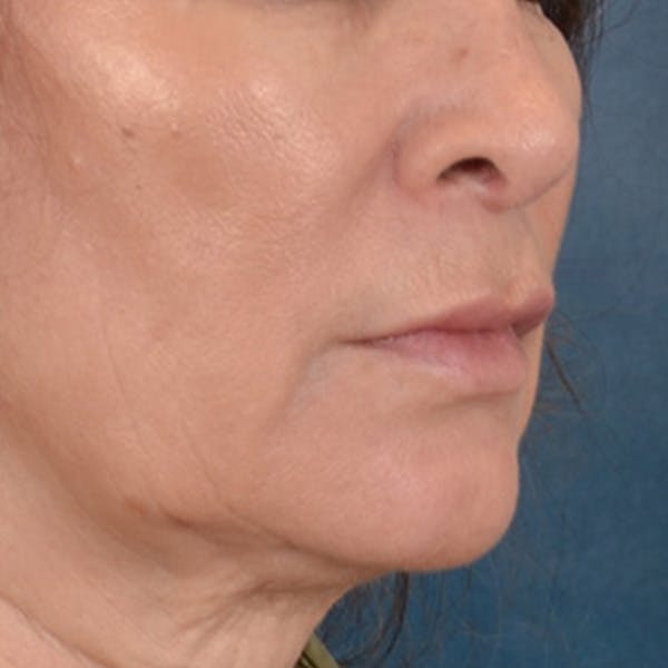Lip Lift Before & After Gallery - Patient 171994 - Image 3
