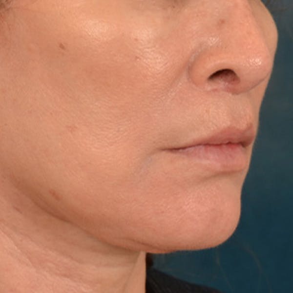 Lip Lift Before & After Gallery - Patient 171994 - Image 4