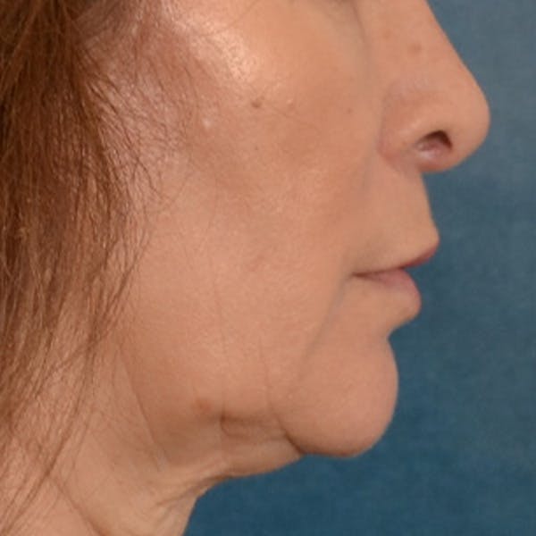 Lip Lift Before & After Gallery - Patient 171994 - Image 5