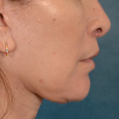 Lip Lift Before & After Gallery - Patient 171994 - Image 6