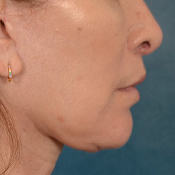 Lip Lift Before & After Gallery - Patient 171994 - Image 6