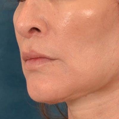 Lip Lift Before & After Gallery - Patient 171994 - Image 8