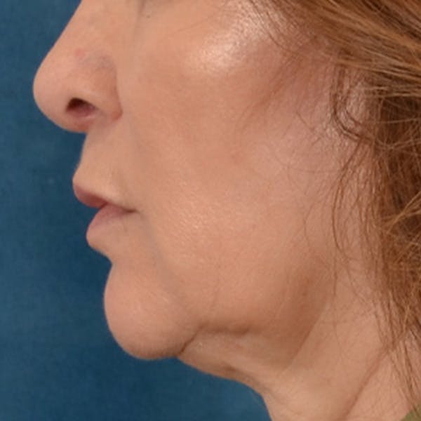 Lip Lift Before & After Gallery - Patient 171994 - Image 9