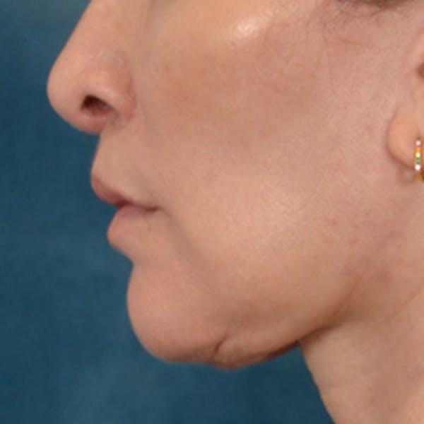 Lip Lift Before & After Gallery - Patient 171994 - Image 10