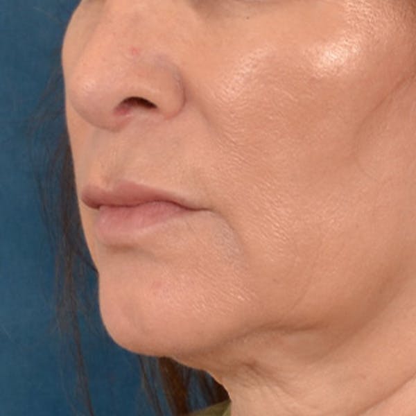 Lip Lift Before & After Gallery - Patient 171994 - Image 7