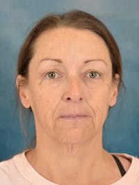 Deep Neck Lift Before & After Gallery - Patient 305927 - Image 1