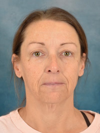 Brow Lift Before & After Gallery - Patient 403586 - Image 1