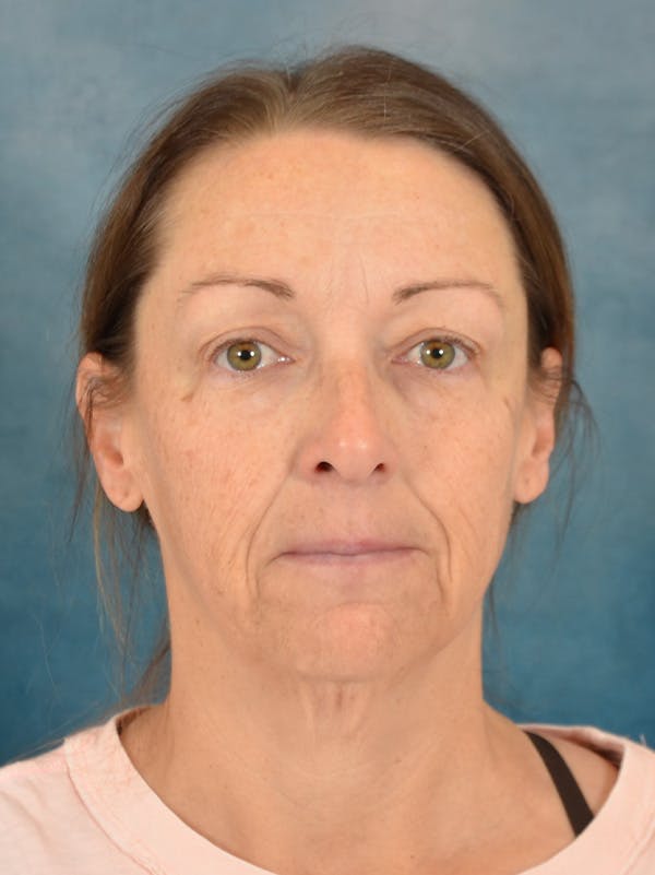 Deep Plane Facelift Before & After Gallery - Patient 212312 - Image 5