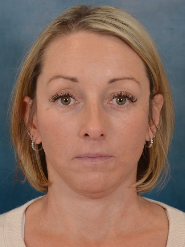 Deep Plane Facelift Before & After Gallery - Patient 212312 - Image 6