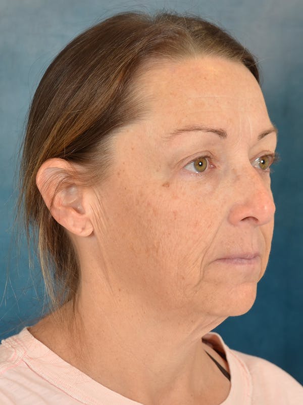 Deep Plane Facelift Before & After Gallery - Patient 212312 - Image 7