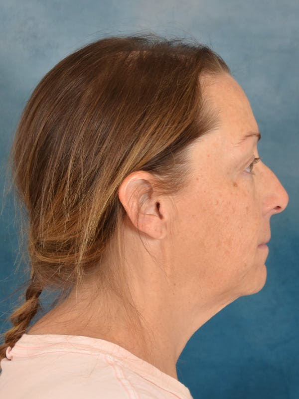 Deep Plane Facelift Before & After Gallery - Patient 212312 - Image 9