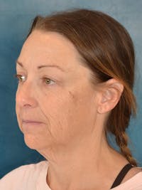 Deep Plane Facelift Before & After Gallery - Patient 148969 - Image 1