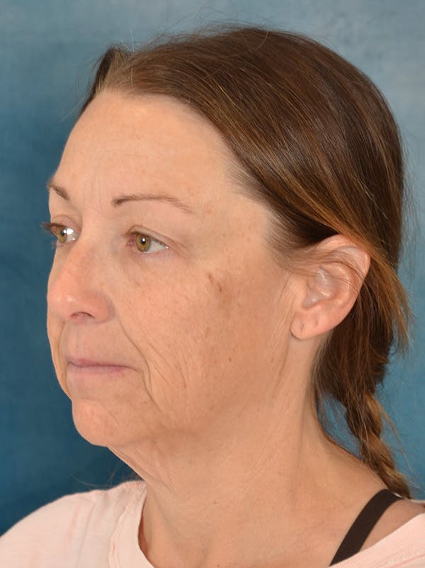 Deep Plane Facelift Before & After Gallery - Patient 212312 - Image 1