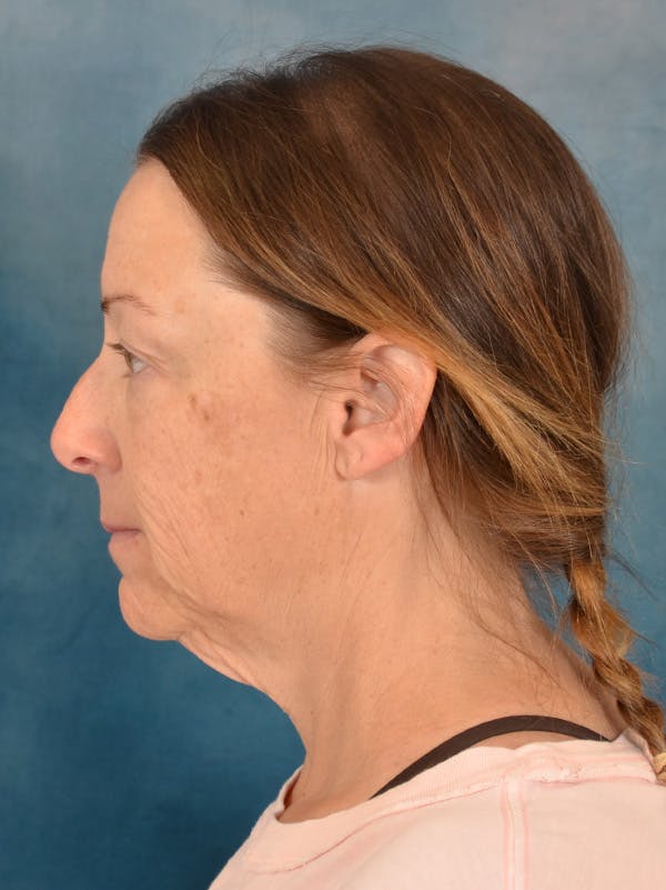 Deep Plane Facelift Before & After Gallery - Patient 212312 - Image 3