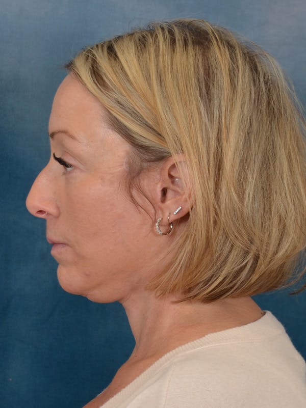 Deep Plane Facelift Before & After Gallery - Patient 212312 - Image 4