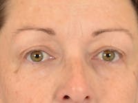 Eyelid Lift Before & After Gallery - Patient 344857 - Image 1