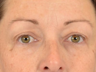 Eyelid Lift Before & After Gallery - Patient 344857 - Image 1