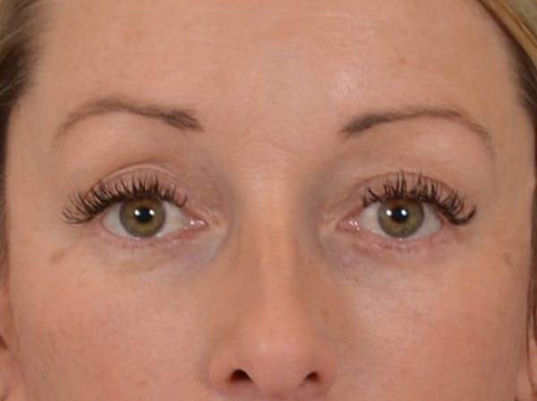 Eyelid Lift Before & After Gallery - Patient 344857 - Image 2