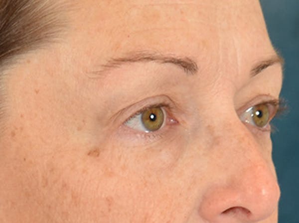 Eyelid Lift Before & After Gallery - Patient 344857 - Image 3