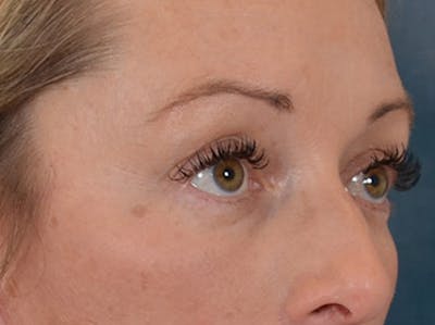 Eyelid Lift Before & After Gallery - Patient 344857 - Image 4