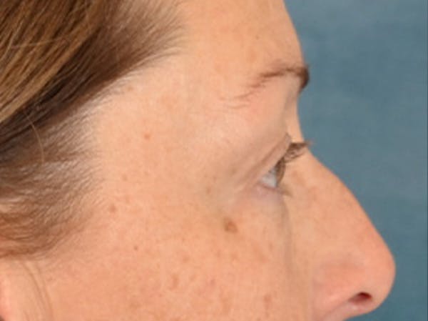 Eyelid Lift Before & After Gallery - Patient 344857 - Image 5