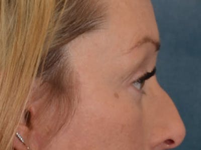 Eyelid Lift Before & After Gallery - Patient 344857 - Image 6