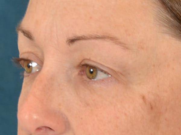 Eyelid Lift Before & After Gallery - Patient 344857 - Image 7