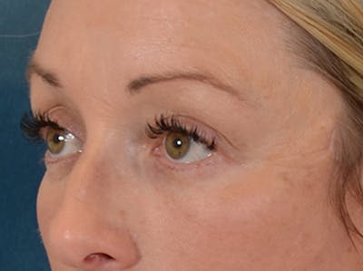 Eyelid Lift Before & After Gallery - Patient 344857 - Image 8