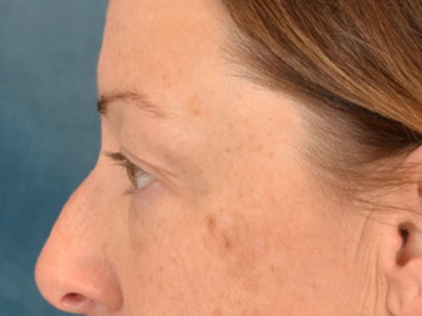 Eyelid Lift Before & After Gallery - Patient 344857 - Image 9