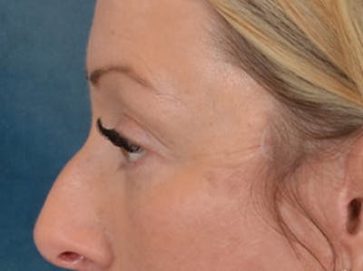 Eyelid Lift Before & After Gallery - Patient 344857 - Image 10