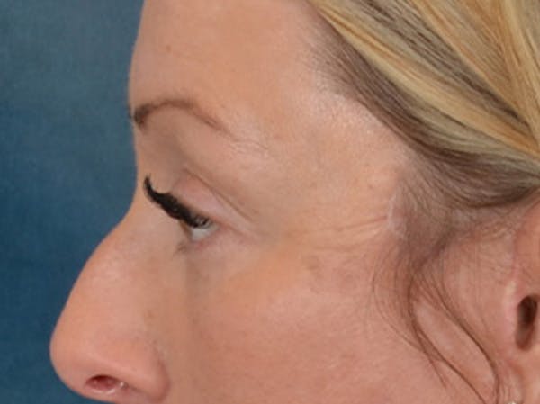 Eyelid Lift Before & After Gallery - Patient 344857 - Image 10