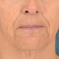 Lip Lift Before & After Gallery - Patient 125162 - Image 1