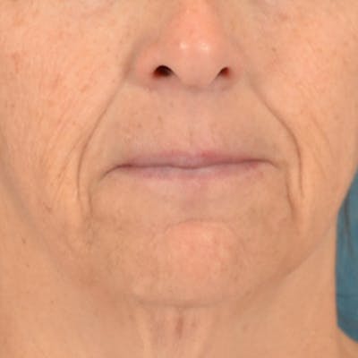 Lip Lift Before & After Gallery - Patient 125162 - Image 1