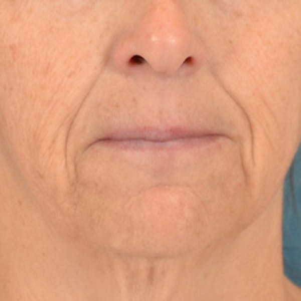 Lip Lift Before & After Gallery - Patient 125162 - Image 1