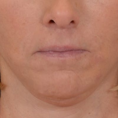 Lip Lift Before & After Gallery - Patient 125162 - Image 2
