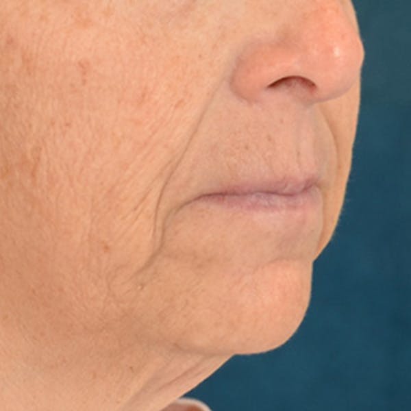 Lip Lift Before & After Gallery - Patient 125162 - Image 3