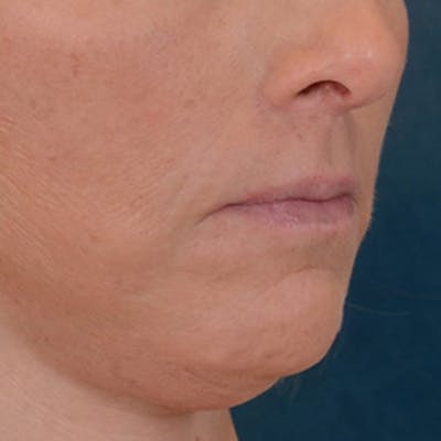 Lip Lift Before & After Gallery - Patient 125162 - Image 4