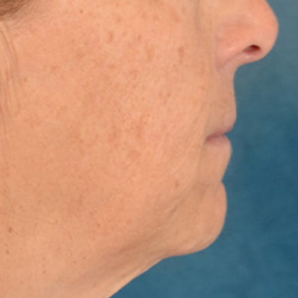 Lip Lift Before & After Gallery - Patient 125162 - Image 5