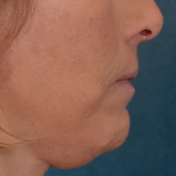 Lip Lift Before & After Gallery - Patient 125162 - Image 6