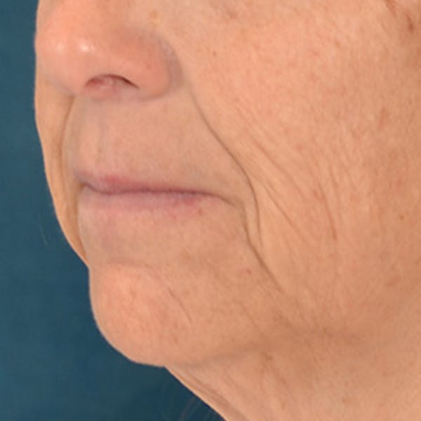 Lip Lift Before & After Gallery - Patient 125162 - Image 7